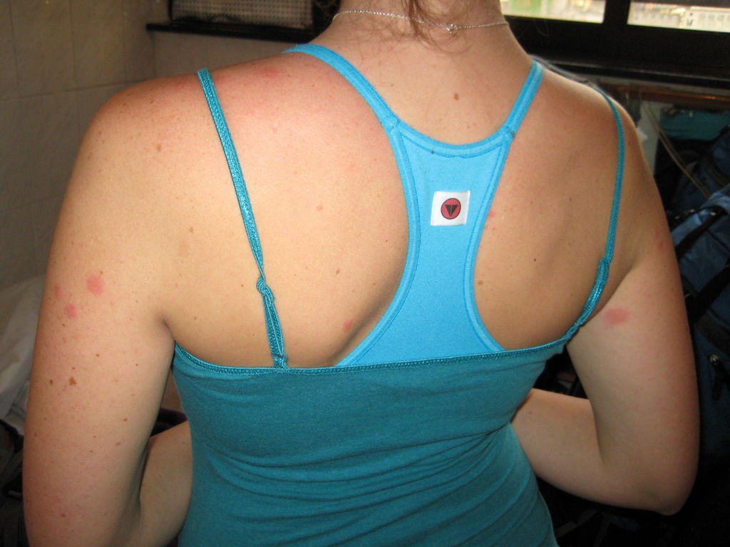 The bed bug bites from the night before