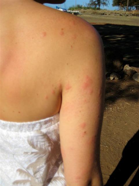 Remainder of the bed bug bites from the hotel